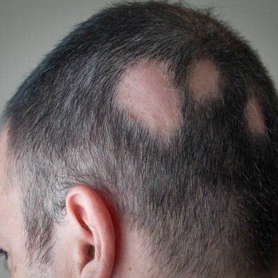 Alopecia Areata Treatments in Islamabad, Rawalpindi & Pakistan