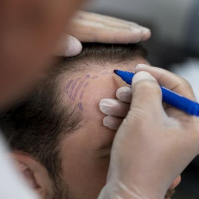 Follicular Unit Transplant (FUT) in Islamabad, Rawalpindi & Pakistan