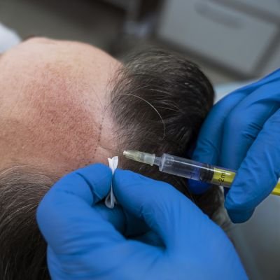 PRP Treatment