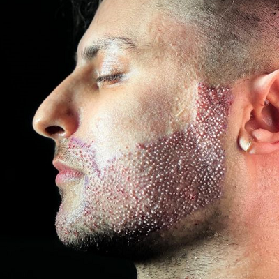 BEARD Hair Transplant in Islamabad