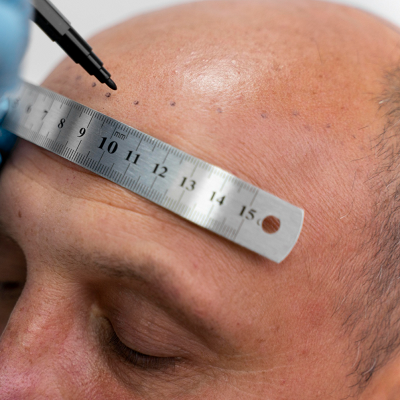 Best Clinic for Hair Transplant Near Me