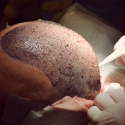 FUE Hair Transplant in Islamabad
