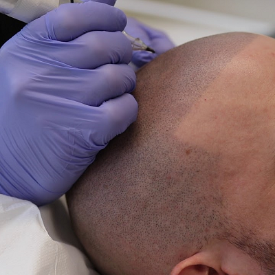 scalp micropigmentation in islamabad pakistan