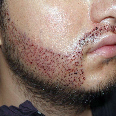 Beard Hair Transplant Cost in Islamabad