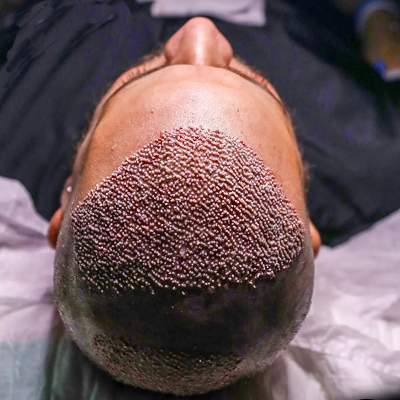 What Age Is Best Suited for a Hair Transplant Procedure?