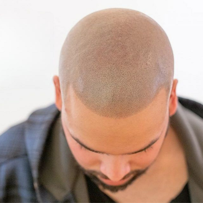 Does Scalp Micropigmentation even look real?