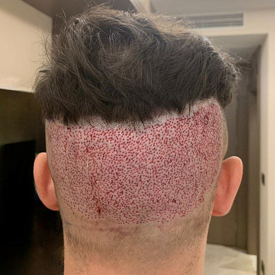 What Happens to Donor Area After Hair Transplant?