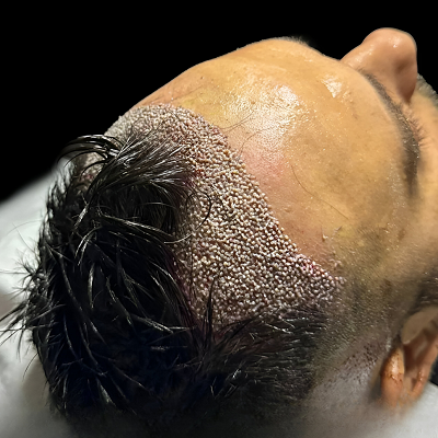What is shock loss after a hair transplant?