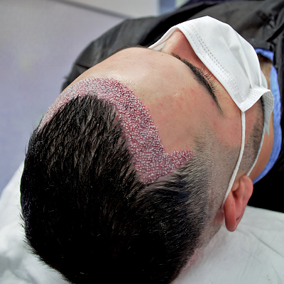 can you touch or scratch your scalp a month after transplant