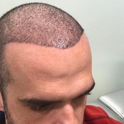 How Good Are Hair Transplants in Pakistan?