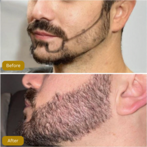 Beard Transplant in Islamabad before and after