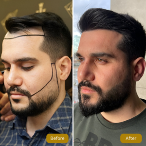 Beard Hair Transplant in Islamabad Before and After