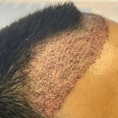 How Many Grafts Do You Need for a Natural Front Hairline?