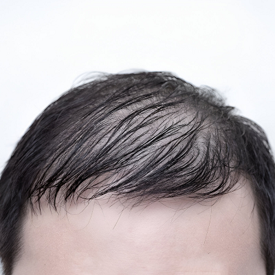 How to treat hair thinning in men?