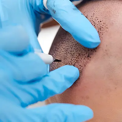 What is the duration of scalp micropigmentation?