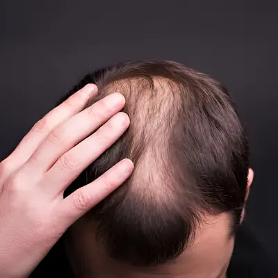 Are exosomes better than PRP?