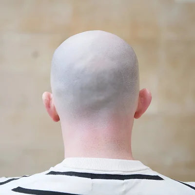 Can you go bald again after a hair transplant?