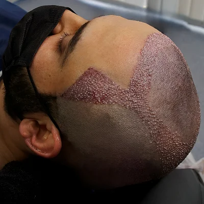 Do hair transplants last a lifetime?