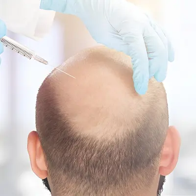 Which is better, PRP or FUE?