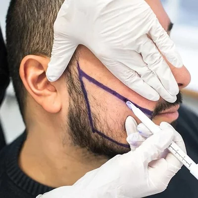 Affordable Beard Hair Transplant Services Near Islamabad