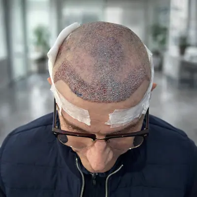 Affordable Hair transplant Packages Near Me