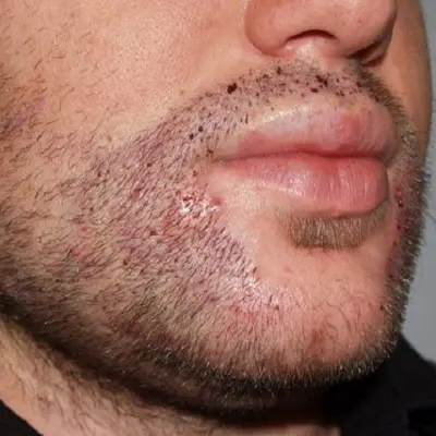 Does a Beard Hair Follicle Transplant Really Work