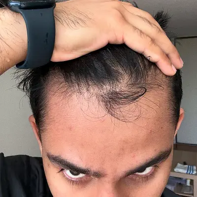 Which Treatment Works Best for Hair Loss