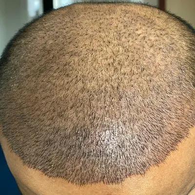 Are These Hair Transplant Results Natural-Looking