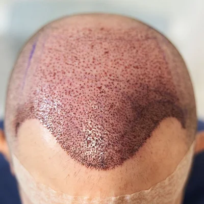 Best Ways to Sleep After an FUE Hair Transplant