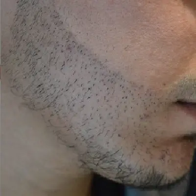 Do Hair Transplants Work on Beards