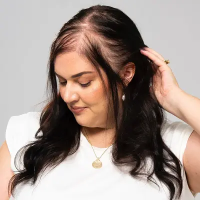 Effective Hair Loss Treatment in Females That Works