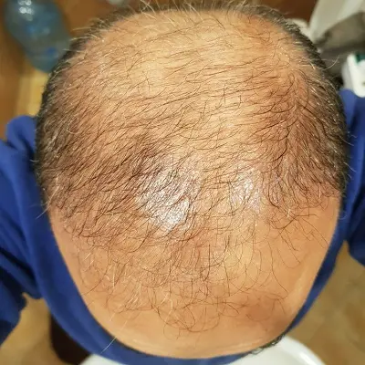 How to Manage Stage 2 Hair Loss Effectively