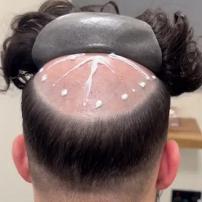 Is It Possible To Wear a Wigs If You Have Alopecia