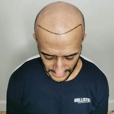 Scalp Micropigmentation Permanent Solution for Hair Loss