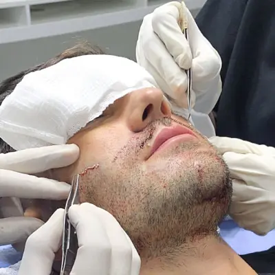 What is The Recovery Time For Beard Restoration Surgery