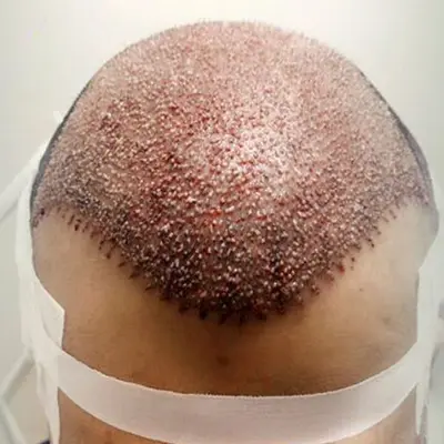 What to Consider Before Opting for a Hair Transplant