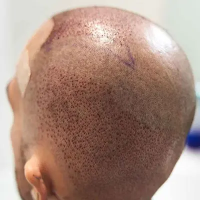 When Does Transplanted Hair Start Growing