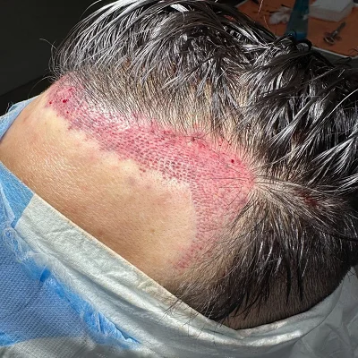 Which City Is Best for Hair Transplant in Pakistan