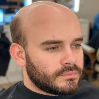 Why Are Wigs Not Common Among Balding Men