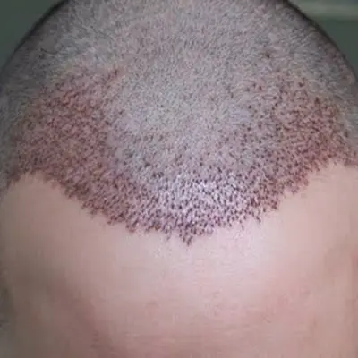 Why Islamabad Is Popular for Hair Transplants