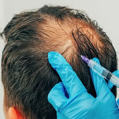 Can Exosomes Be Combined With Microneedling Treatment