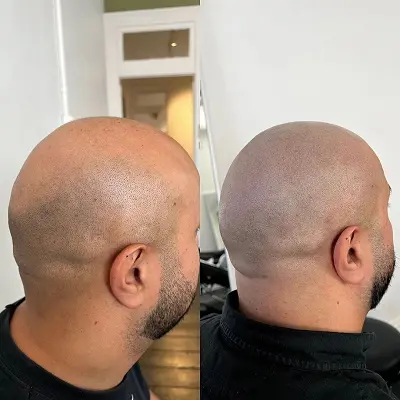 Can Scalp Micropigmentation Cause Hair Loss