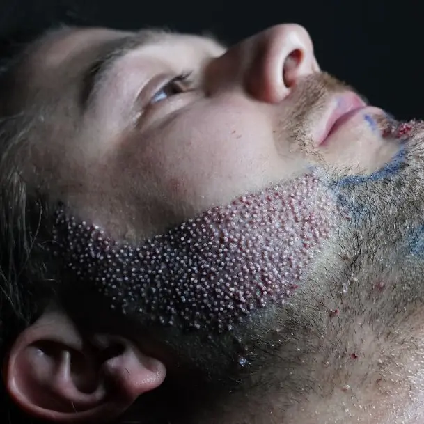 Do they use scalp hair for beard transplants