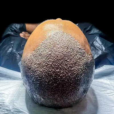 Does Hair Transplant Have Side Effects