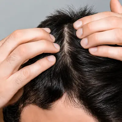How does DHT affect hair follicles