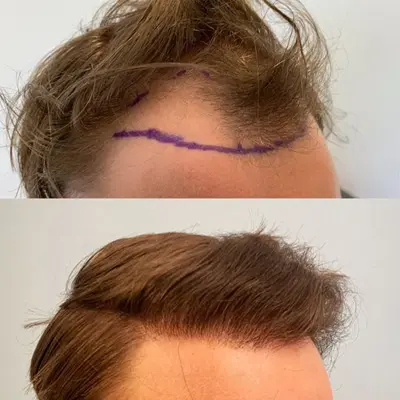 How Many Grafts Are Needed To Cover The Crown Area