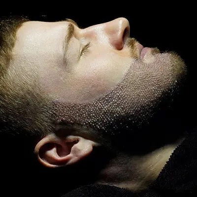 How Soon Can You Shave After a Beard Transplant