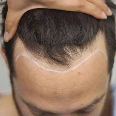 In Which Cases Is a Hair Transplant Not Suitable
