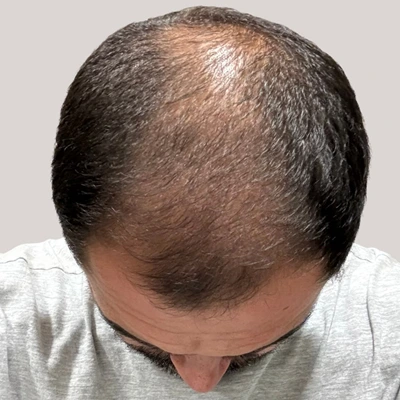Which Hair Loss Treatment Is Best For Men