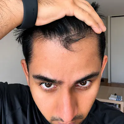 Top Benefits of Getting Hair Fall Treatment in Pakistan